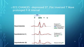 o ECG CHANGES -depressed ST ,Flat/inversed T Wave
prolonged P-R interval
25
 