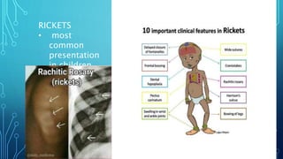 RICKETS
• most
common
presentation
in children
34
 