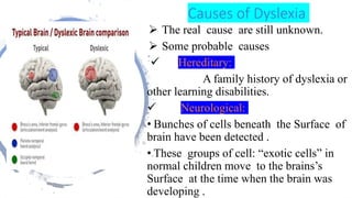 D yselixa (reading ,writing and spell disability) | PPTX