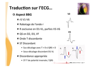 CHU_Hôpitaux de Rouen - page 11
!  Aspect	
  BBG	
  
!  rS	
  V1-­‐V6	
  	
  
!  Rabotage	
  de	
  l'onde	
  r	
  
!  R	
  exclusive	
  en	
  D1-­‐VL,	
  parfois	
  V5-­‐V6	
  
!  QS	
  en	
  D2,	
  D3,	
  VF	
  
!  Onde	
  T	
  discordante	
  
!  ST	
  Discordant	
  
•  Sus-­‐décalage	
  avec	
  T	
  >	
  0	
  si	
  QRS	
  <	
  0	
  
•  Sous-­‐décalage	
  discordant	
  D1	
  VL	
  
!  Discordance	
  appropriée	
  
•  ST-­‐T	
  de	
  polarité	
  inversée	
  /	
  QRS	
  
	
  
V2	
  
V5	
  
TraducTon	
  sur	
  l’ECG…	
  
 