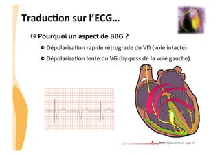 CHU_Hôpitaux de Rouen - page 12
TraducTon	
  sur	
  l’ECG…	
  
!  Pourquoi	
  un	
  aspect	
  de	
  BBG	
  ?	
  
!  Dépolarisa%on	
  rapide	
  rétrograde	
  du	
  VD	
  (voie	
  intacte)	
  
!  Dépolarisa%on	
  lente	
  du	
  VG	
  (by-­‐pass	
  de	
  la	
  voie	
  gauche)	
  
 