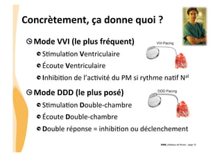 CHU_Hôpitaux de Rouen - page 15
Concrètement,	
  ça	
  donne	
  quoi	
  ?	
  
!  Mode	
  VVI	
  (le	
  plus	
  fréquent)	
  
!  S%mula%on	
  Ventriculaire	
  
!  Écoute	
  Ventriculaire	
  
!  Inhibi%on	
  de	
  l’ac%vité	
  du	
  PM	
  si	
  rythme	
  na%f	
  Nal	
  
!  Mode	
  DDD	
  (le	
  plus	
  posé)	
  
!  S%mula%on	
  Double-­‐chambre	
  
!  Écoute	
  Double-­‐chambre	
  
!  Double	
  réponse	
  =	
  inhibi%on	
  ou	
  déclenchement	
  
 