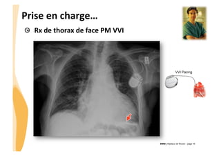 CHU_Hôpitaux de Rouen - page 16
Prise	
  en	
  charge…	
  
! Rx	
  de	
  thorax	
  de	
  face	
  PM	
  VVI	
  
 