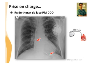 CHU_Hôpitaux de Rouen - page 17
Prise	
  en	
  charge…	
  
! Rx	
  de	
  thorax	
  de	
  face	
  PM	
  DDD	
  
 