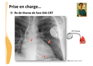 CHU_Hôpitaux de Rouen - page 18
Prise	
  en	
  charge…	
  
! Rx	
  de	
  thorax	
  de	
  face	
  DAI-­‐CRT	
  
 