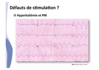 CHU_Hôpitaux de Rouen - page 23
Défauts	
  de	
  sTmulaTon	
  ?	
  
!  Hyperkaliémie	
  et	
  PM	
  
	
  
 