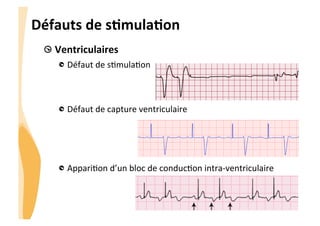 CHU_Hôpitaux de Rouen - page 25
Défauts	
  de	
  sTmulaTon	
  
!  Ventriculaires	
  
!  Défaut	
  de	
  s%mula%on	
  
	
  
	
  
!  Défaut	
  de	
  capture	
  ventriculaire	
  
!  Appari%on	
  d’un	
  bloc	
  de	
  conduc%on	
  intra-­‐ventriculaire	
  
	
  
!
 