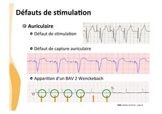 CHU_Hôpitaux de Rouen - page 26
Défauts	
  de	
  sTmulaTon	
  
!  Auriculaire	
  
!  Défaut	
  de	
  s%mula%on	
  
	
  
!  Défaut	
  de	
  capture	
  auriculaire	
  
!  Appari%on	
  d’un	
  BAV	
  2	
  Wenckebach	
  
	
  
 