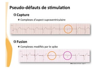 CHU_Hôpitaux de Rouen - page 27
Pseudo-­‐défauts	
  de	
  sTmulaTon	
  
!  Capture	
  
!  Complexes	
  d’aspect	
  supraventriculaire	
  
	
  
!  Fusion	
  
!  Complexes	
  modiﬁés	
  par	
  le	
  spike	
  
 