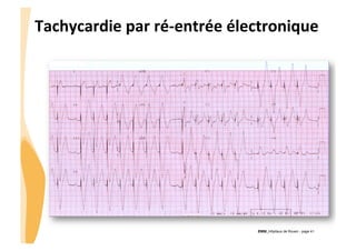 CHU_Hôpitaux de Rouen - page 41
Tachycardie	
  par	
  ré-­‐entrée	
  électronique	
  
 