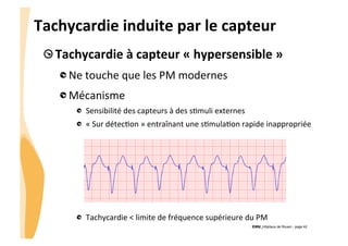 CHU_Hôpitaux de Rouen - page 42
Tachycardie	
  induite	
  par	
  le	
  capteur	
  
!  Tachycardie	
  à	
  capteur	
  «	
  hypersensible	
  »	
  
!  Ne	
  touche	
  que	
  les	
  PM	
  modernes	
  
!  Mécanisme	
  
!   Sensibilité	
  des	
  capteurs	
  à	
  des	
  s%muli	
  externes	
  
!   «	
  Sur	
  détec%on	
  »	
  entraînant	
  une	
  s%mula%on	
  rapide	
  inappropriée	
  
	
  
!   Tachycardie	
  <	
  limite	
  de	
  fréquence	
  supérieure	
  du	
  PM	
  	
  
 