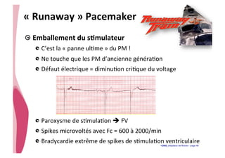 • CHU_Hôpitaux de Rouen - page 48
«	
  Runaway	
  »	
  Pacemaker	
  
!  Emballement	
  du	
  sTmulateur	
  
!  C’est	
  la	
  «	
  panne	
  ul%me	
  »	
  du	
  PM	
  !	
  
!  Ne	
  touche	
  que	
  les	
  PM	
  d’ancienne	
  généra%on	
  
!  Défaut	
  électrique	
  =	
  diminu%on	
  cri%que	
  du	
  voltage	
  
!  Paroxysme	
  de	
  s%mula%on	
  è	
  FV	
  
! Spikes	
  microvoltés	
  avec	
  Fc	
  =	
  600	
  à	
  2000/min	
  
!  Bradycardie	
  extrême	
  de	
  spikes	
  de	
  s%mula%on	
  ventriculaire
 