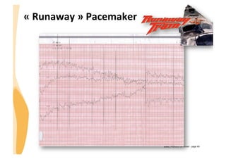 CHU_Hôpitaux de Rouen - page 49
«	
  Runaway	
  »	
  Pacemaker	
  
 