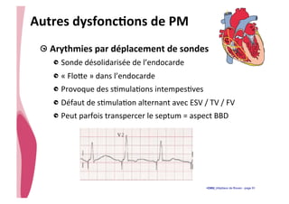 • CHU_Hôpitaux de Rouen - page 51
Autres	
  dysfoncTons	
  de	
  PM	
  
!  Arythmies	
  par	
  déplacement	
  de	
  sondes	
  
!  Sonde	
  désolidarisée	
  de	
  l’endocarde	
  
!  «	
  Flo{e	
  »	
  dans	
  l’endocarde	
  
!  Provoque	
  des	
  s%mula%ons	
  intempes%ves	
  
!  Défaut	
  de	
  s%mula%on	
  alternant	
  avec	
  ESV	
  /	
  TV	
  /	
  FV	
  
!  Peut	
  parfois	
  transpercer	
  le	
  septum	
  =	
  aspect	
  BBD	
  
 