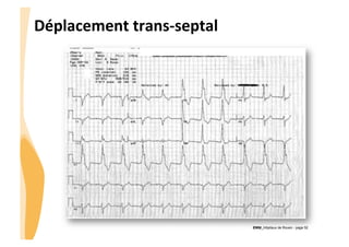 CHU_Hôpitaux de Rouen - page 52
Déplacement	
  trans-­‐septal	
  
 