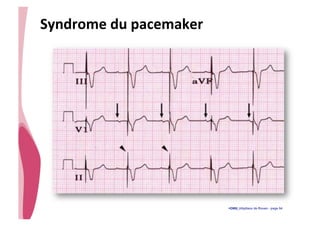 • CHU_Hôpitaux de Rouen - page 54
Syndrome	
  du	
  pacemaker
 