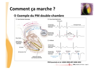 CHU_Hôpitaux de Rouen - page 9
Comment	
  ça	
  marche	
  ?	
  
!  Exemple	
  du	
  PM	
  double-­‐chambre	
  	
  
FM	
  Kusumoto	
  et	
  al.	
  JAMA	
  2002;287:1848-­‐1852	
  
 
