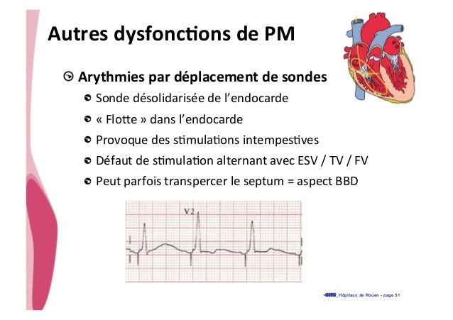 Dysfonction d'un pm urgences 2014 slideshare - 웹