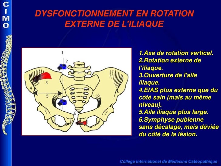 Dysfonction iliaque int externe exemple web Dysfonction iliaque int externe exemple web