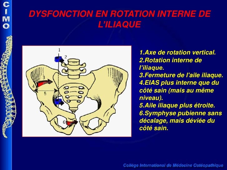 Dysfonction iliaque int externe exemple web Dysfonction iliaque int externe exemple web