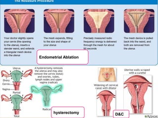 Endometrial Ablation
hysterectomy D&C
 