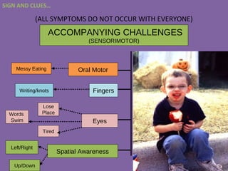 (ALL SYMPTOMS DO NOT OCCUR WITH EVERYONE)
ACCOMPANYING CHALLENGES
(SENSORIMOTOR)
Oral MotorMessy Eating
Writing/knots Fingers
Eyes
Tired
Words
Swim
Lose
Place
Spatial Awareness
Up/Down
Left/Right
SIGN AND CLUES…
 