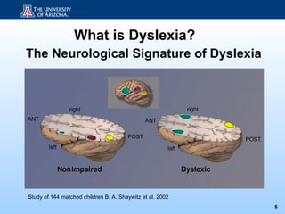What is Dyslexia?
The Neurological Signature of Dyslexia




Study of 144 matched children B. A. Shaywitz et al. 2002
                                                           6
 