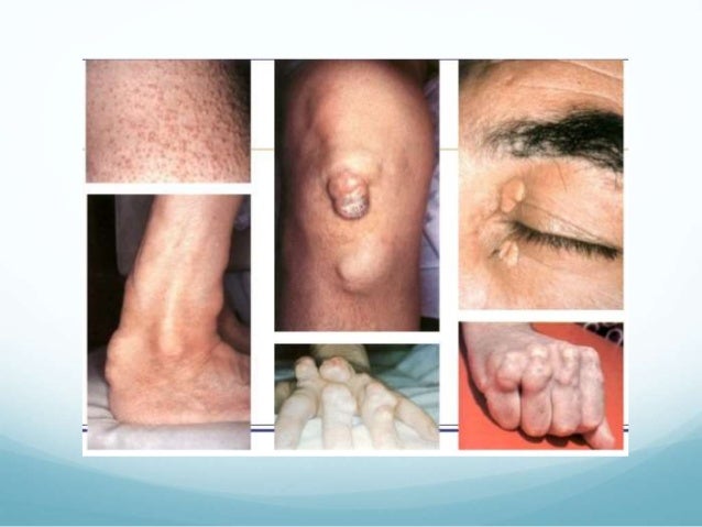 Dyslipidemia