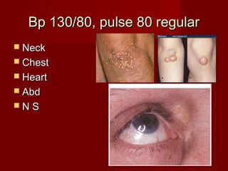 Bp 130/80, pulse 80 regular
 Neck
 Chest
 Heart
 Abd
NS
 