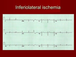 Inferiolateral ischemia
 