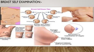 BREAST SELF EXAMINATION:-
 