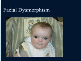 Approach to Dysmorphic Infant or Child | PPTX