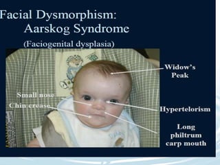 Approach to Dysmorphic Infant or Child | PPTX
