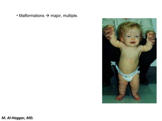 • Malformations  major, multiple.
M. Al-Haggar, MD.
 