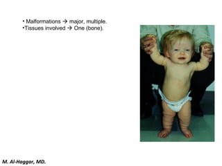 • Malformations  major, multiple.
•Tissues involved  One (bone).
M. Al-Haggar, MD.
 