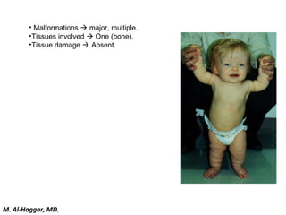 • Malformations  major, multiple.
•Tissues involved  One (bone).
•Tissue damage  Absent.
M. Al-Haggar, MD.
 