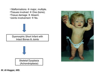 • Malformations  major, multiple.
•Tissues involved  One (bone).
•Tissue damage  Absent.
•Joints involvement  No.
Dysmorphic Short Infant with
Intact Bones & Joints
Skeletal Dysplasia
(Achondroplasia)
M. Al-Haggar, MD.
 