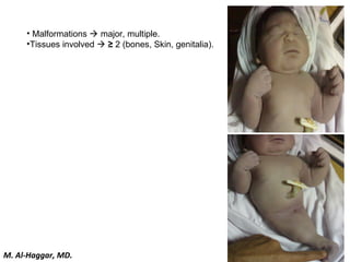 • Malformations  major, multiple.
•Tissues involved  ≥ 2 (bones, Skin, genitalia).
M. Al-Haggar, MD.
 