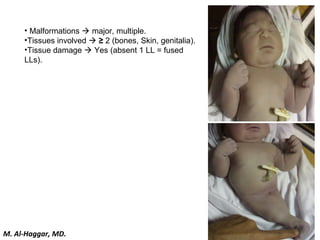 • Malformations  major, multiple.
•Tissues involved  ≥ 2 (bones, Skin, genitalia).
•Tissue damage  Yes (absent 1 LL = fused
LLs).
M. Al-Haggar, MD.
 