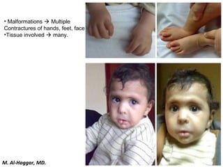 • Malformations  Multiple
Contractures of hands, feet, face
•Tissue involved  many.
M. Al-Haggar, MD.
 