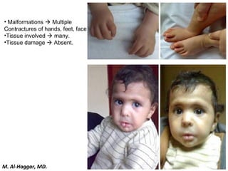 • Malformations  Multiple
Contractures of hands, feet, face
•Tissue involved  many.
•Tissue damage  Absent.
M. Al-Haggar, MD.
 