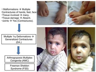• Malformations  Multiple
Contractures of hands, feet, face
•Tissue involved  many.
•Tissue damage  Absent.
•Joints  Yes (Contractures).
Multiple 1ry Deformations 
Generalized Contractures
(DA.)
Arthrogryposis Multiplex
Congenita (AMC)
Freeman Sheldon
Syndrome (FSS)
 