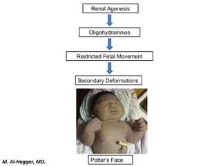 Secondary Deformations
Restricted Fetal Movement
Potter’s Face
Renal Agenesis
Oligohydramnios
M. Al-Haggar, MD.
 