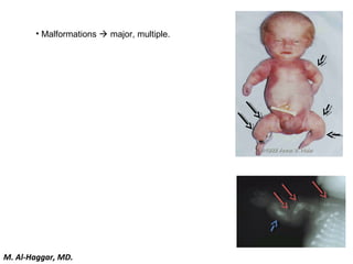 • Malformations  major, multiple.
M. Al-Haggar, MD.
 