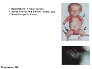 • Malformations  major, multiple.
•Tissues involved  ≥ 2 (bones, Sclera, Ear).
•Tissue damage  Absent.
M. Al-Haggar, MD.
 