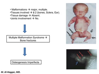 • Malformations  major, multiple.
•Tissues involved  ≥ 2 (bones, Sclera, Ear).
•Tissue damage  Absent.
•Joints involvement  No.
Multiple Malformation Syndrome 
Bone fractures
Osteogenesis Imperfecta
M. Al-Haggar, MD.
 