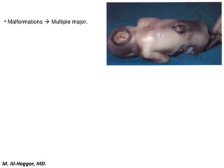 • Malformations  Multiple major.
M. Al-Haggar, MD.
 