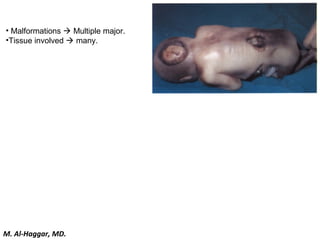 • Malformations  Multiple major.
•Tissue involved  many.
M. Al-Haggar, MD.
 