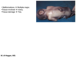 • Malformations  Multiple major.
•Tissue involved  many.
•Tissue damage  Yes.
M. Al-Haggar, MD.
 