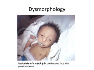 Dysmorphology
Seckel dwarfism (AR.)  bird headed face with
prominent nose
 